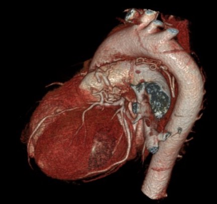 FÃstula arterial coronaria compleja de origen congénito